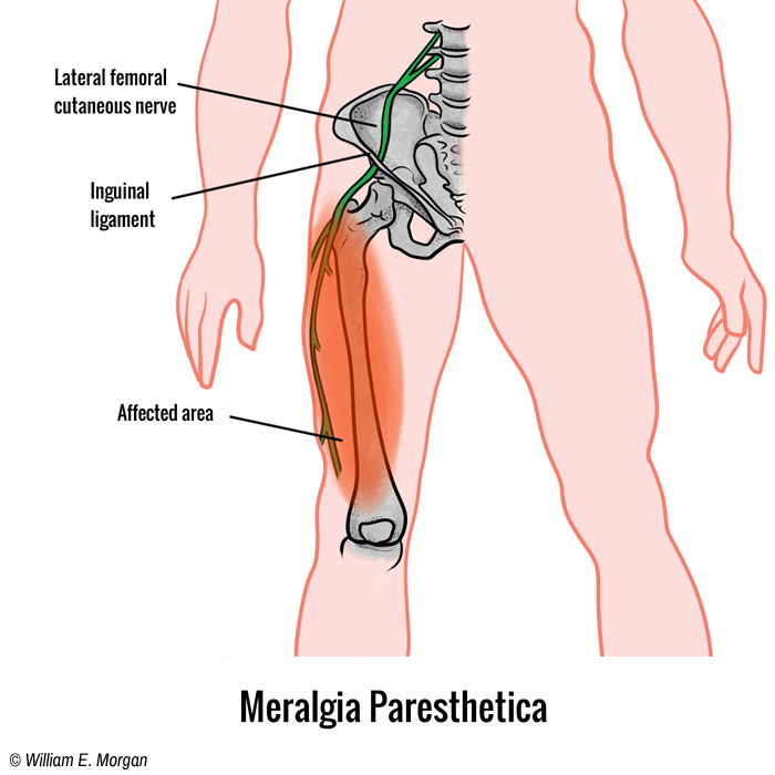 Meralgia Paresthetica skinny jean syndrome Dr. William E. Morgan