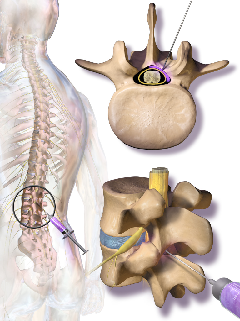 epidural injection