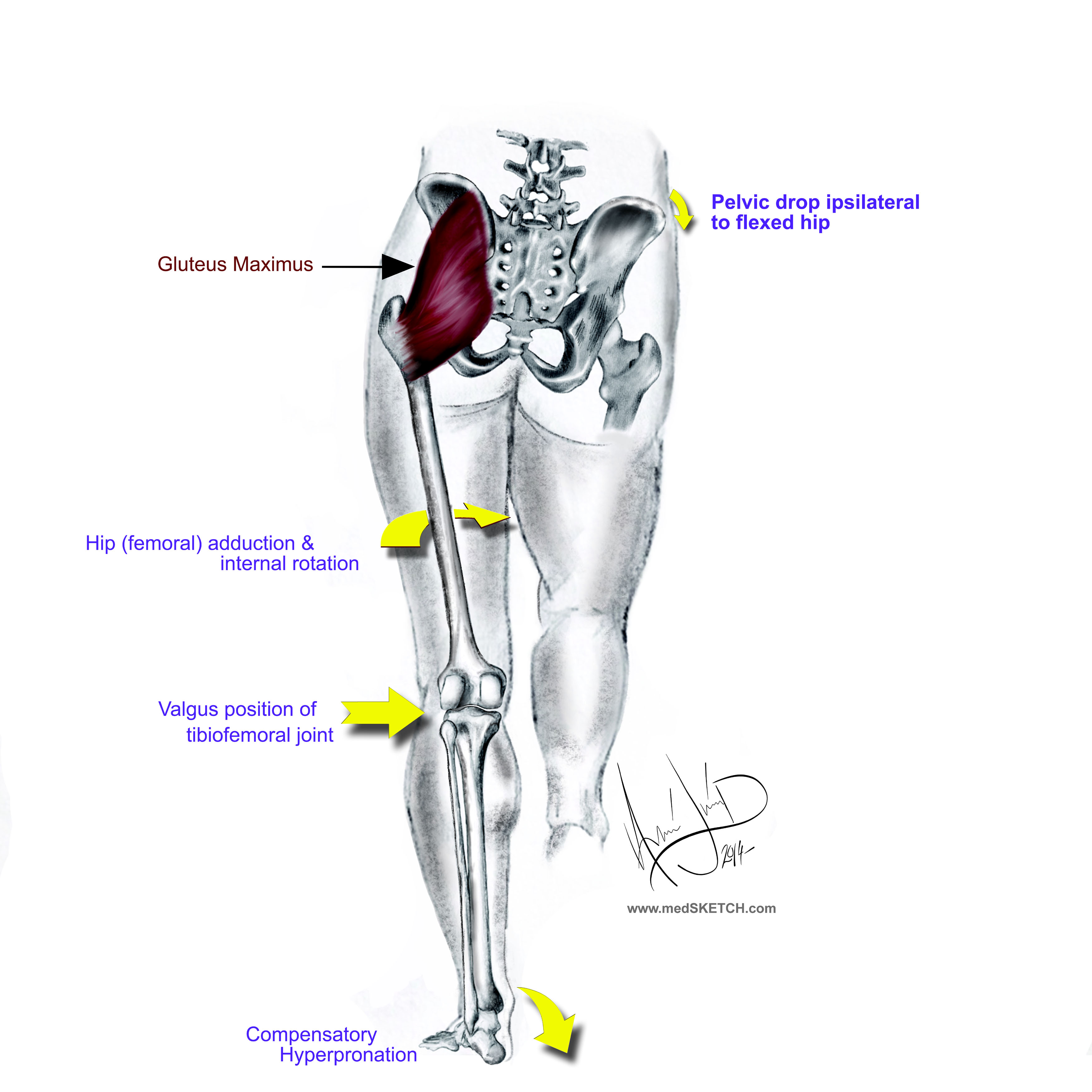 Figure 2.  Gluteus maximus weakness creates a cascade of events that increases the likelihood of injury.  GM weakness causes a contralateral pelvic lowering, ipsilateral internal rotation of the femur which results in a valgus position of the knee and compensatory hyperpronation. 