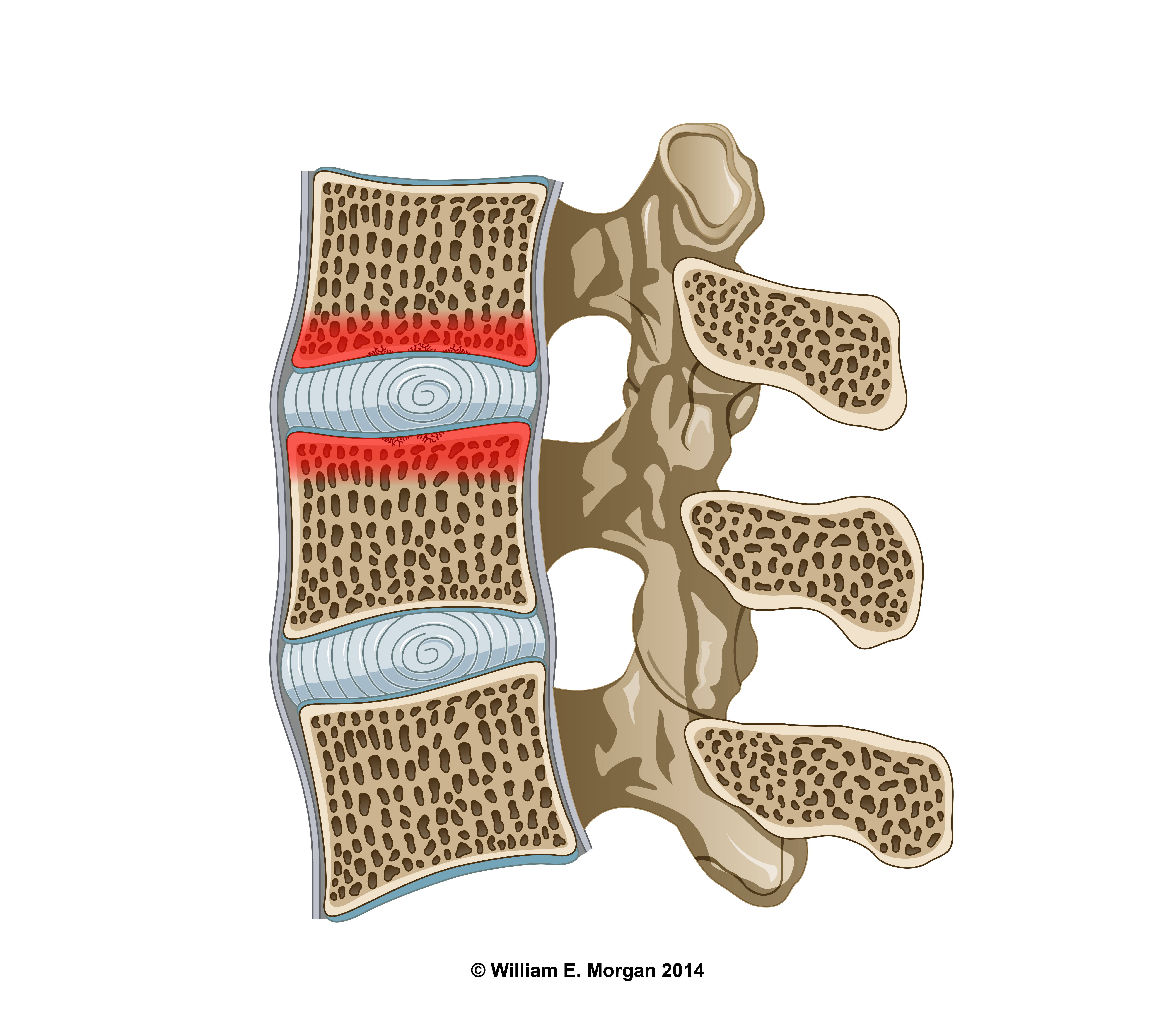 Bony edema (red) extending into the spongy subcortical bone. 