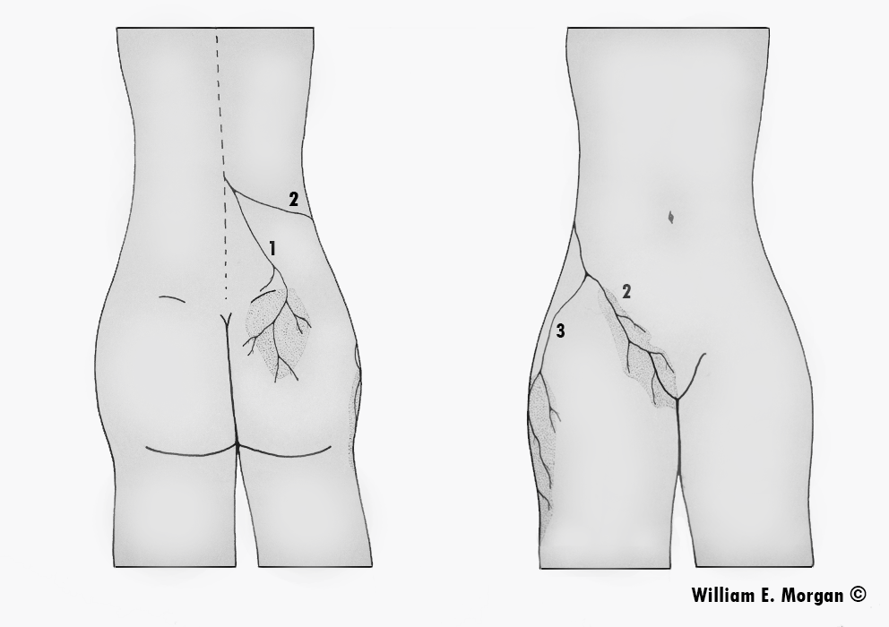 Maigne's syndrome, cluneal nerve