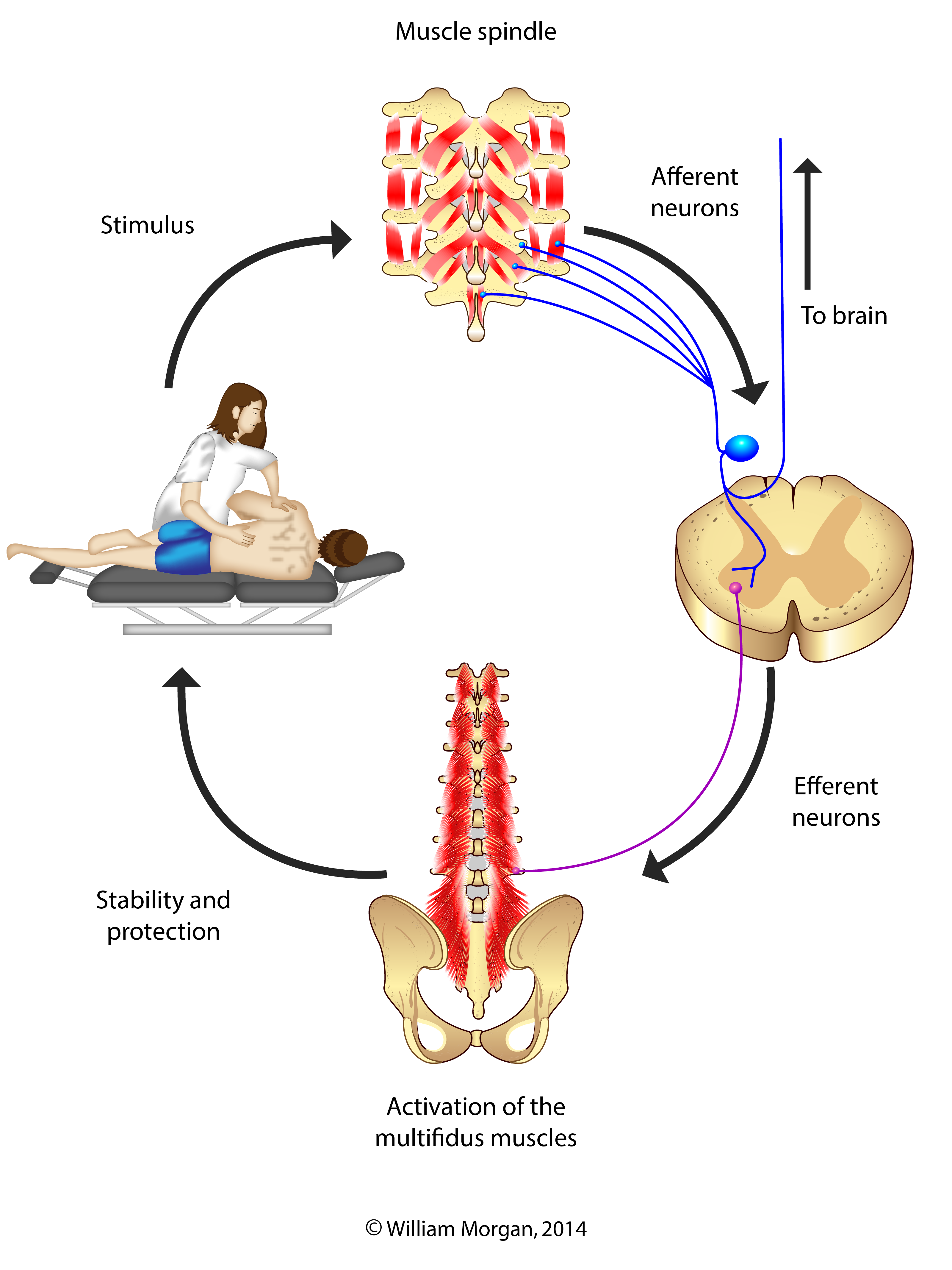 Combined neuromuscular electrical stimulation with motor control exercise  can improve lumbar multifidus activation in individuals with recurrent low back  pain