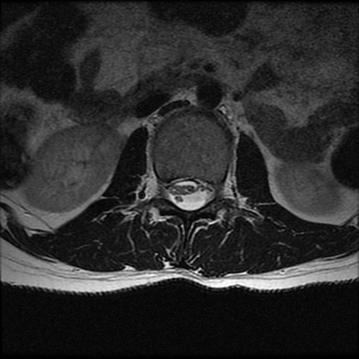 Clumping together of the nerve rootlets in adhesive arachnoiditis.